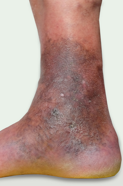 Understanding Venous Ulcers